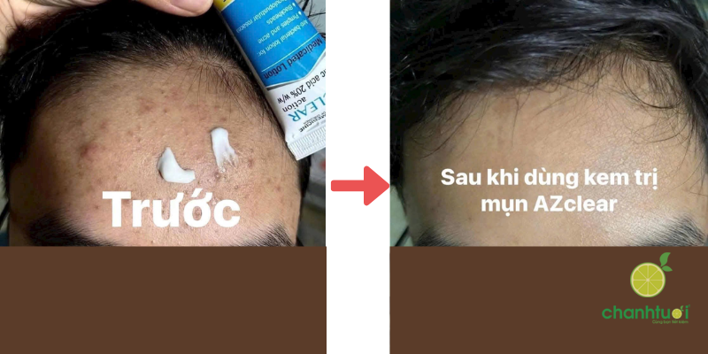 Azclear 20% Azelaic acid 2