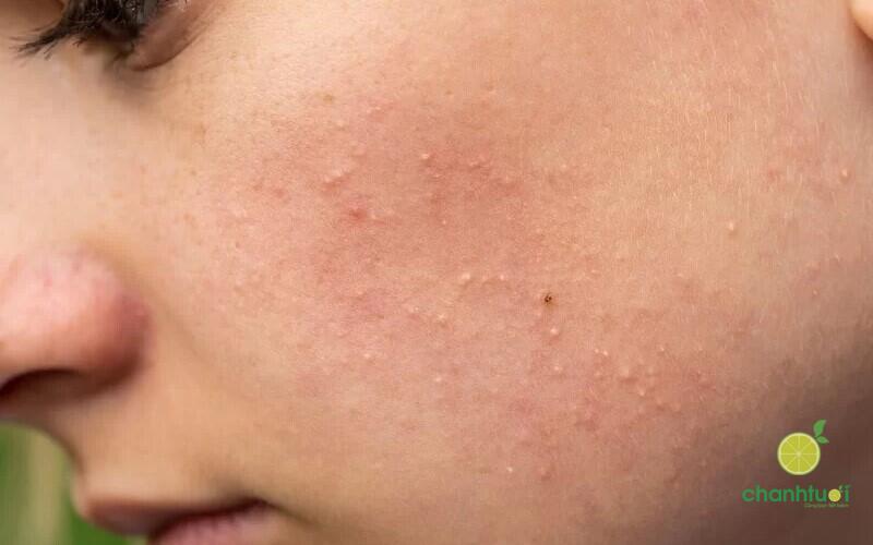 Azelaic acid có đẩy mụn không 2