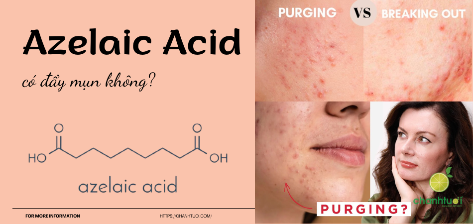 Azelaic acid có đẩy mụn không? Sự thật bạn cần biết