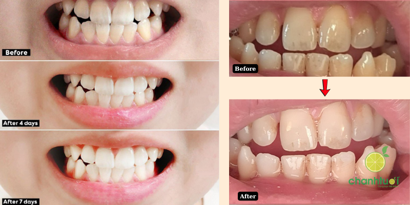 bột tẩy trắng răng Eucryl hiệu quả