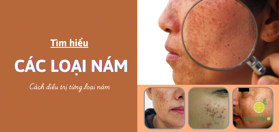 Hiểu rõ về các loại nám da phổ biến để điều trị đúng cách