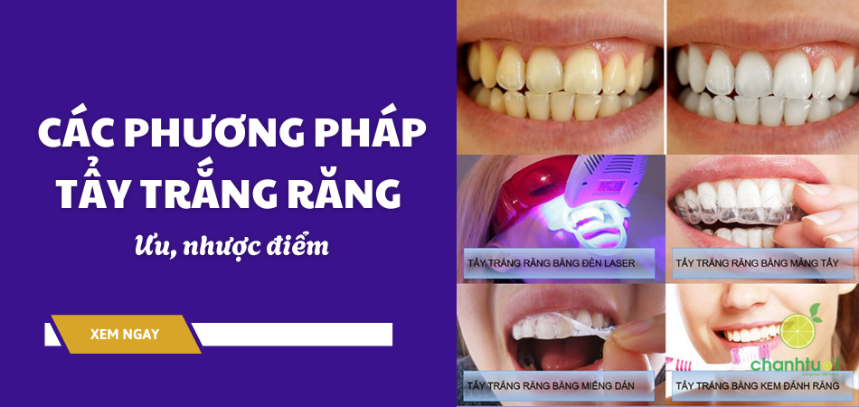 Ưu, nhược điểm của các phương pháp tẩy trắng răng hiện nay