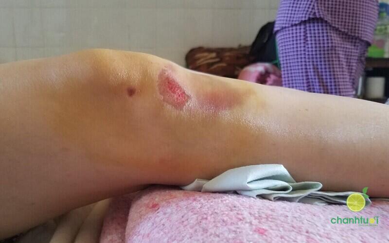 Cách bôi nghệ tươi trị sẹo 2