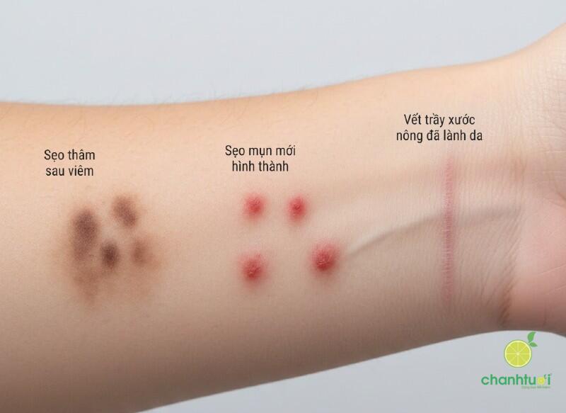 Cách bôi nghệ tươi trị sẹo 3