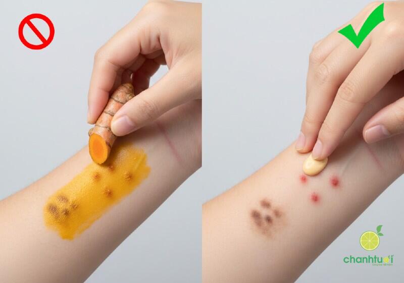 Cách bôi nghệ tươi trị sẹo 5