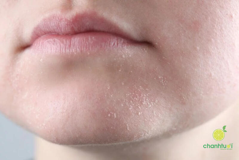 cấp ẩm cho da khô 1