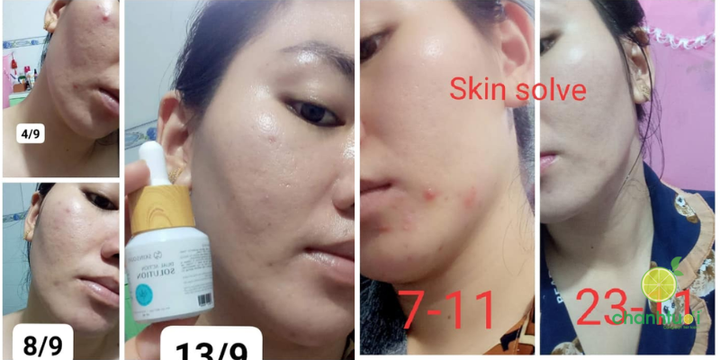 chấm mụn Dual Action Skinsolve 2