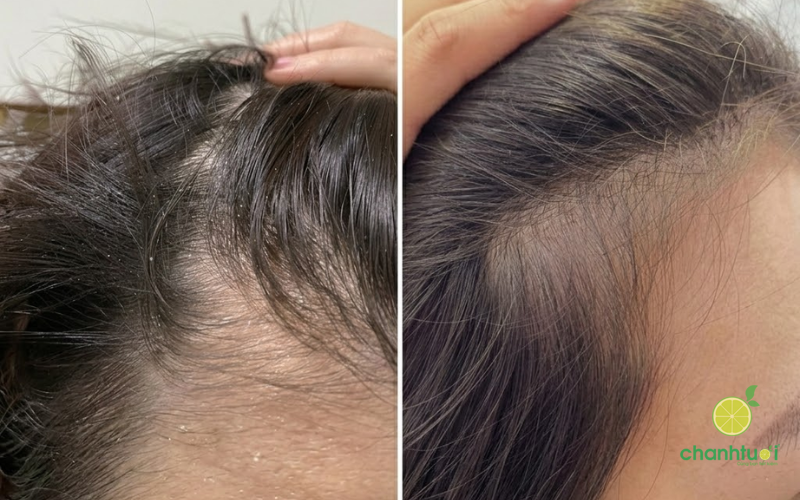 dầu gội santal x 2 (1)