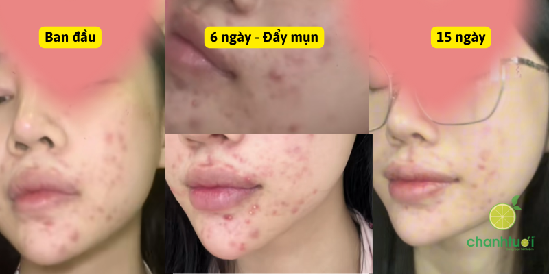 erylik gel hiệu quả (1)