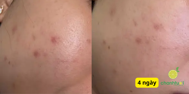 Ezanic Azelaic Acid Gel 20 KẾT QUẢ 2