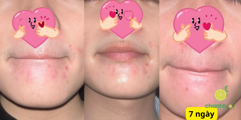 Ezanic Azelaic Acid Gel 20 kết quả trị thâm