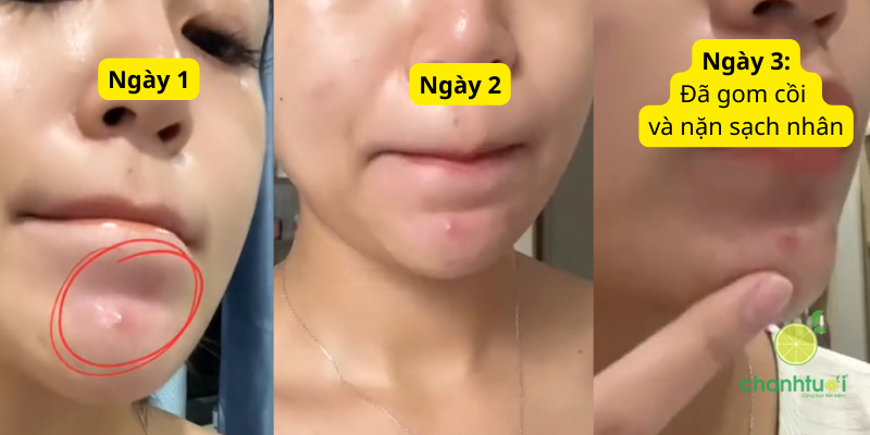 Ezanic Azelaic Acid Gel 20 kết quả