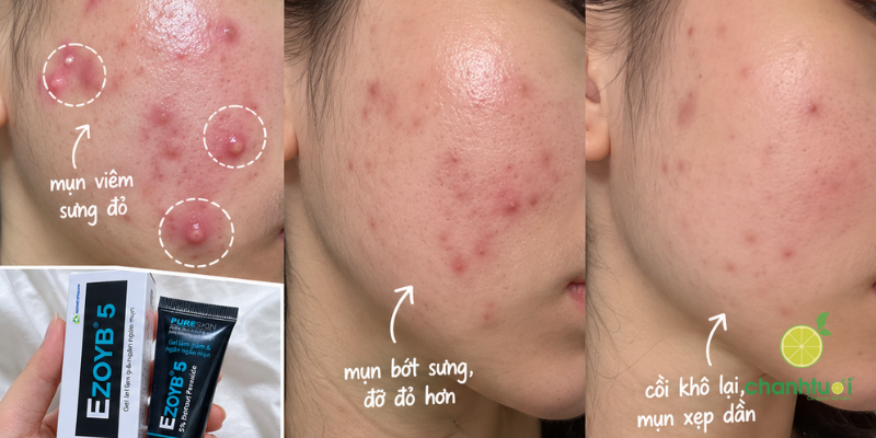 Gel mụn Ezoyb 5 2