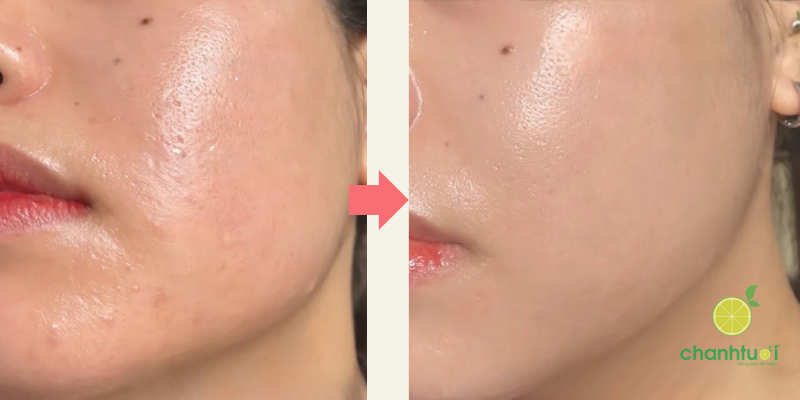 Hiệu quả eucerin anti pigment dual serum