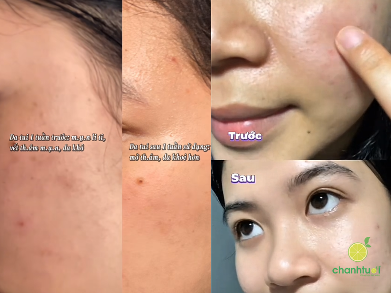 hiệu quả kem dưỡng Benzac Microbiome Equaliser (1)