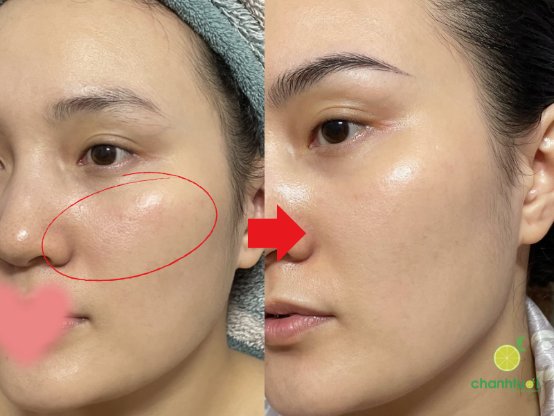 hiệu quả kem dưỡng kinetin obagi