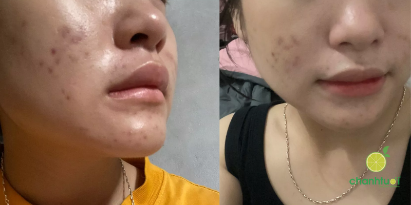 hiệu quả serum jumiso niacinamide 20