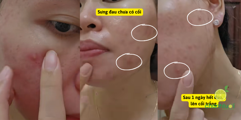 hiệu quả thuốc chấm mụn Novolinda