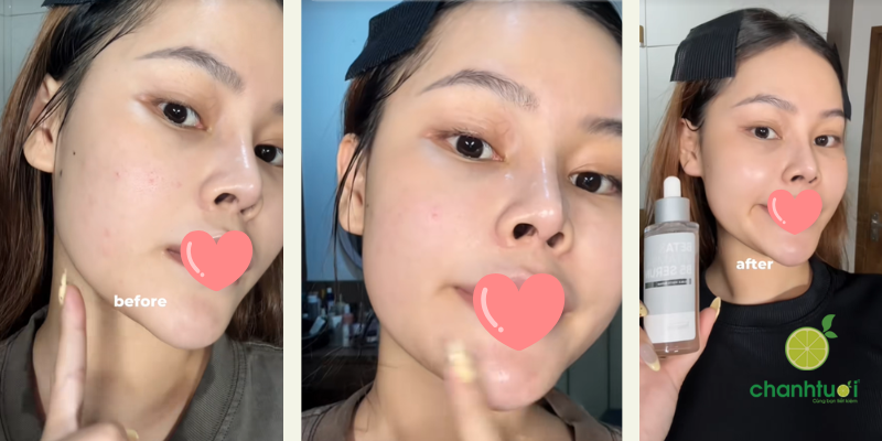 innoskin beta & vitamin b5 serum hiệu quả