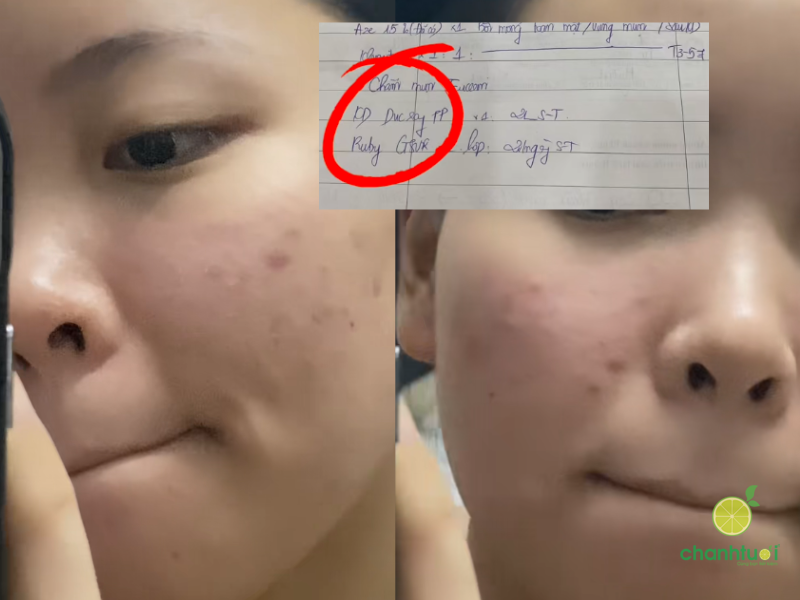 kem dưỡng ẩm Ducray Keracnyl PP da ban đầu