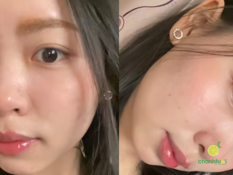 kem dưỡng ẩm Ducray Keracnyl PP kết quả