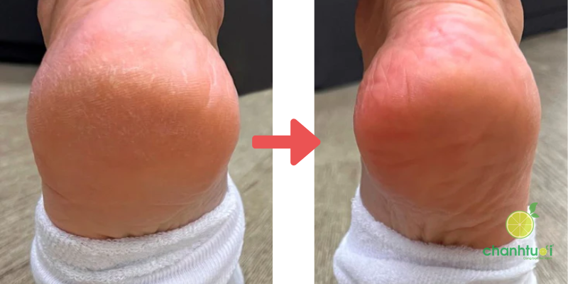 Kem Dưỡng Nứt Nẻ Gót Chân Ziaja Foot Cream 3