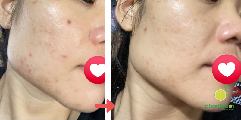 kem dưỡng SVR Sebiaclear Active hiệu quả