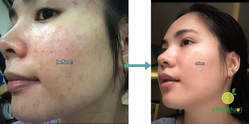 kem trị mụn differin 1