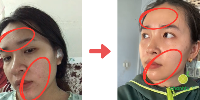 kem trị mụn megaduo 2