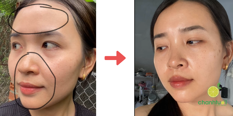 kem trị mụn megaduo 3