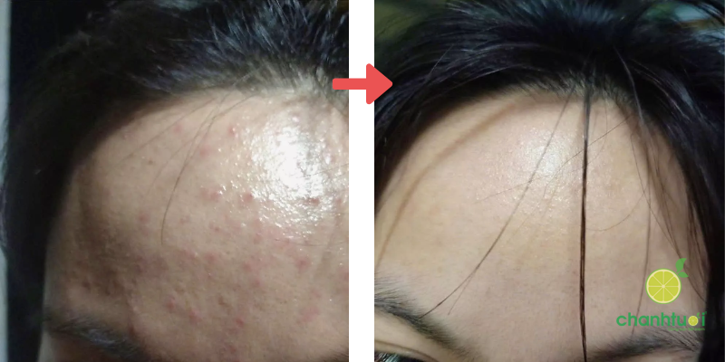 kem trị mụn trioderma 3