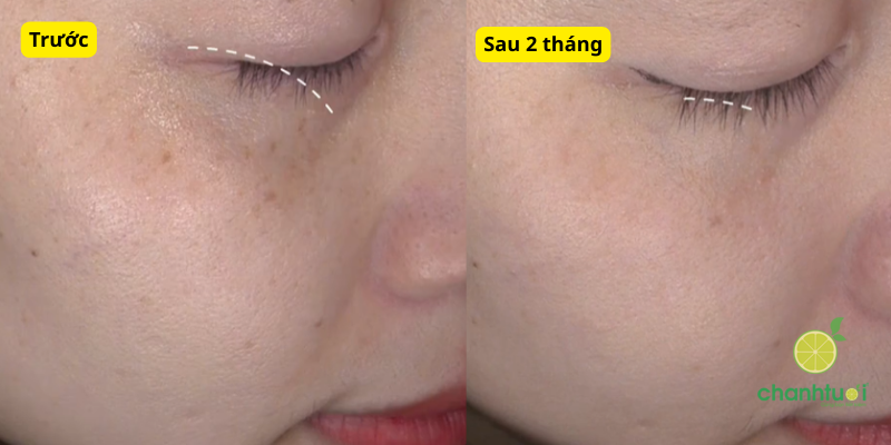 kem trị nám cyntra kết quả