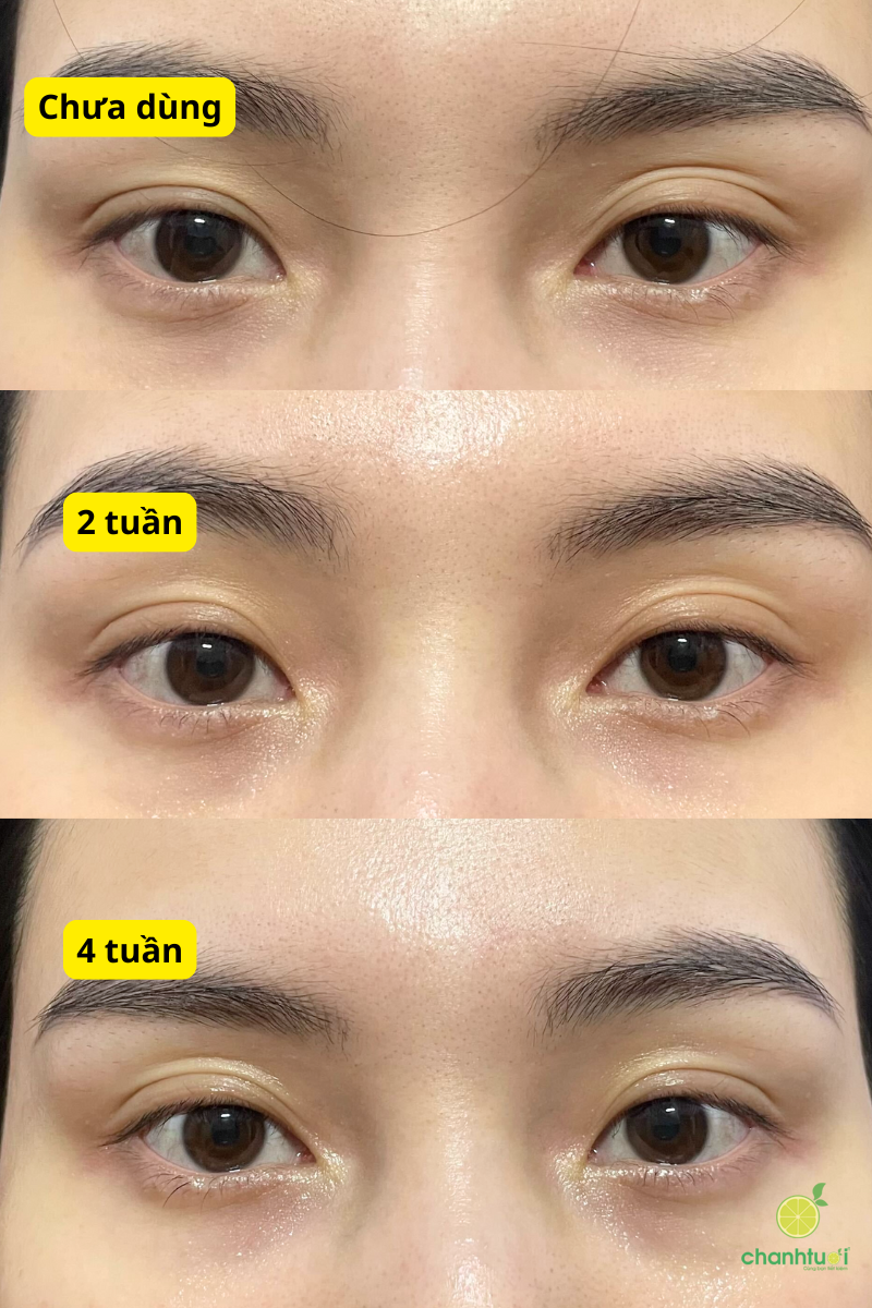 kết quả dùng kem mắt AHC đỏ