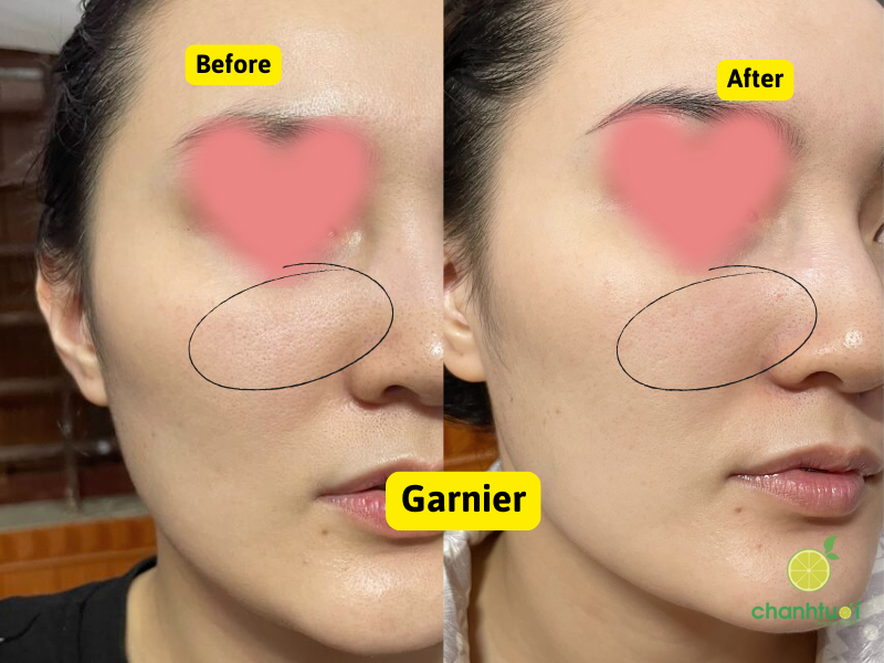 kết quả peel da garnier và loreal