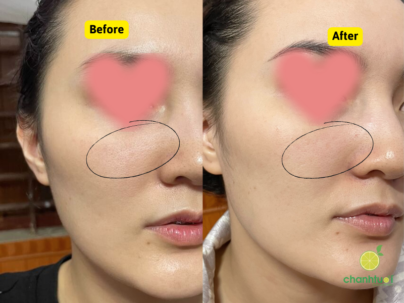 kết quả serum peel garnier