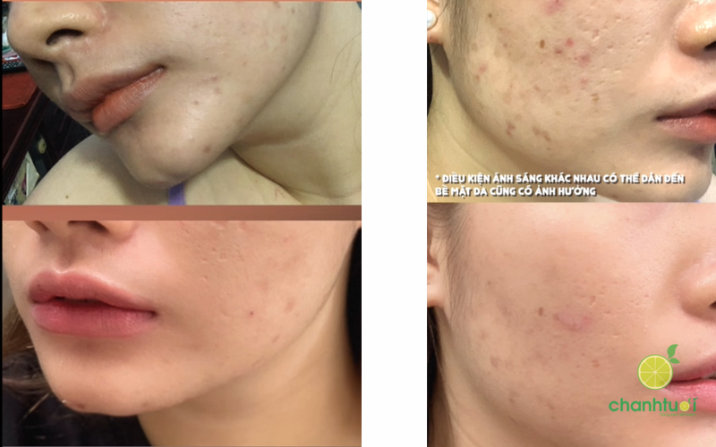 La Roche Posay Effaclar Duo 2