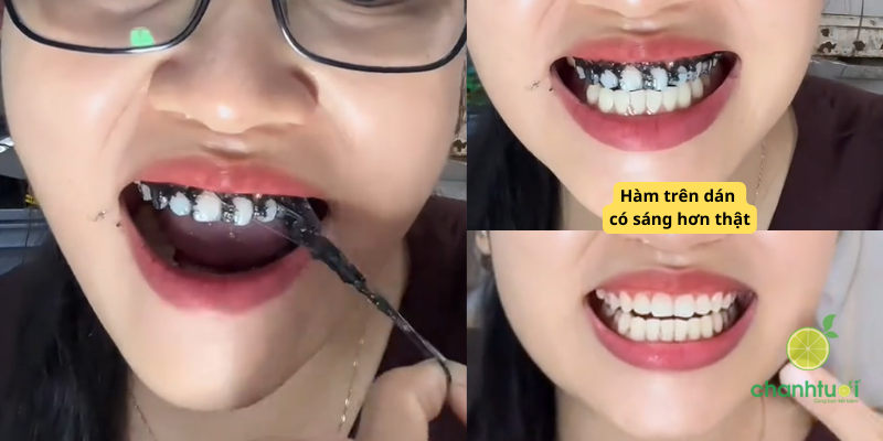 miếng dán trắng răng Anriea 2