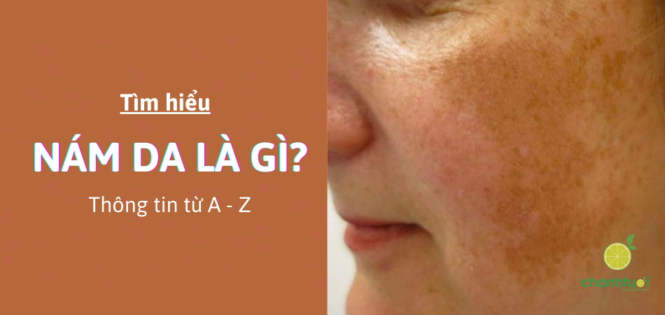 Tổng quan về nám da: Kiến thức đầy đủ A–Z bạn cần biết