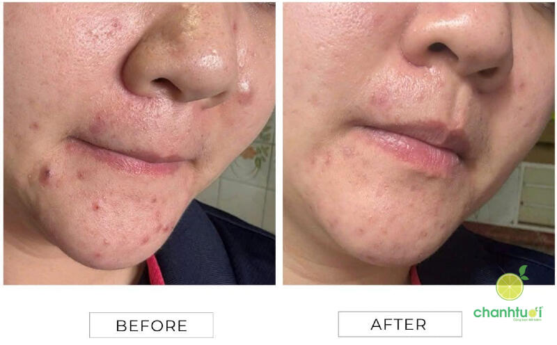 Orobanc Phyto - B3 Acne Control Ampoule 2