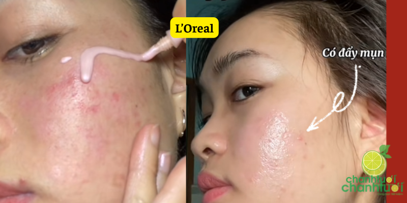 peel da garnier và loreal kết quả 2 (1)