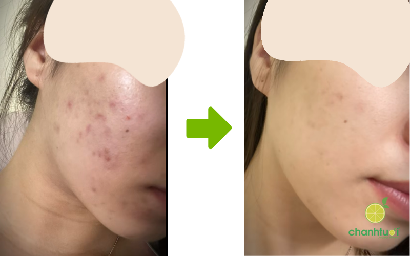 Review dầu dưỡng linoleic twins skin 5