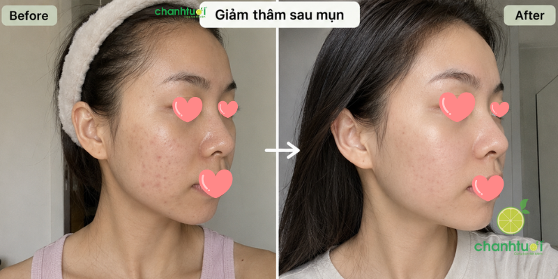 Serum pharmaform aze lift hiệu quả 2