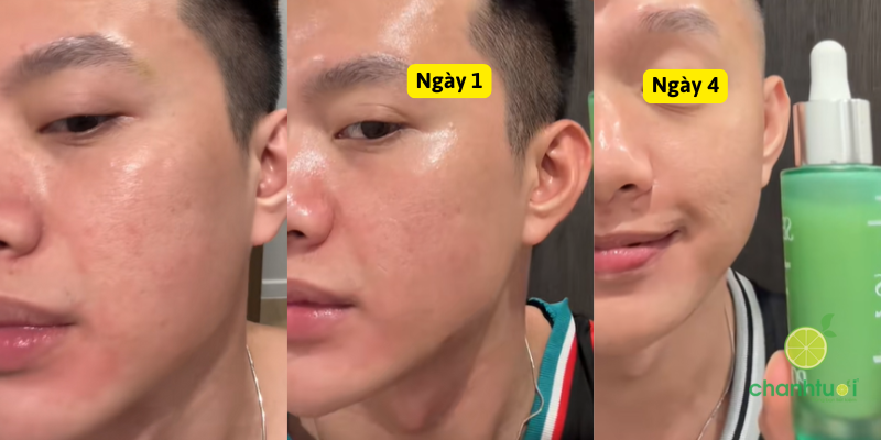 Serum Tiền Lợi Khuẩn Poreves 4