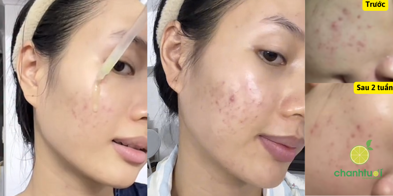 Serum Tiền Lợi Khuẩn Poreves 5