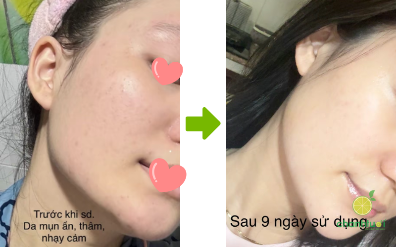 Serum Vitamin K Prettyskin hiệu quả