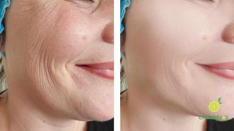 skin boosters 3