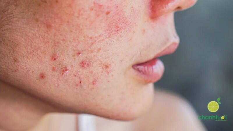 skin boosters 4