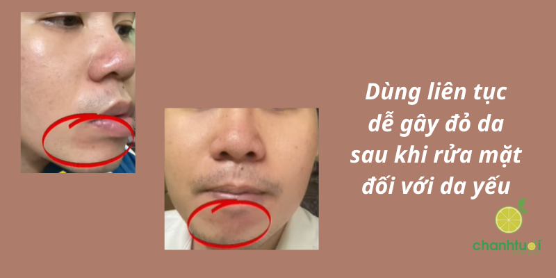 Sodowe Relaxing Sulfur Soap kích ứng