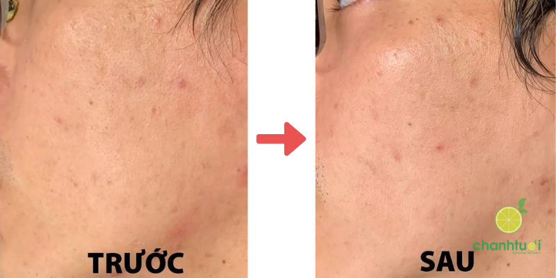 sữa rửa mặt MD CARE Mandelic Acid 2