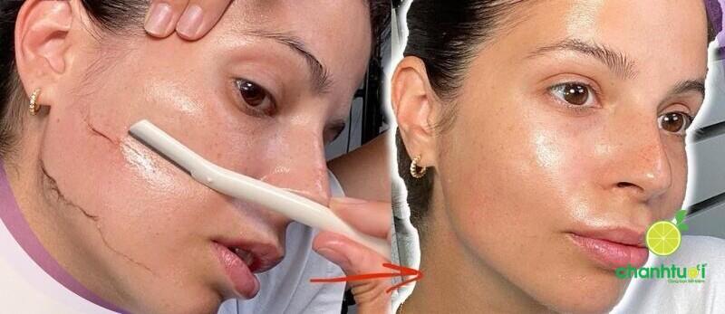 Triệt lông mặt 3 (1)